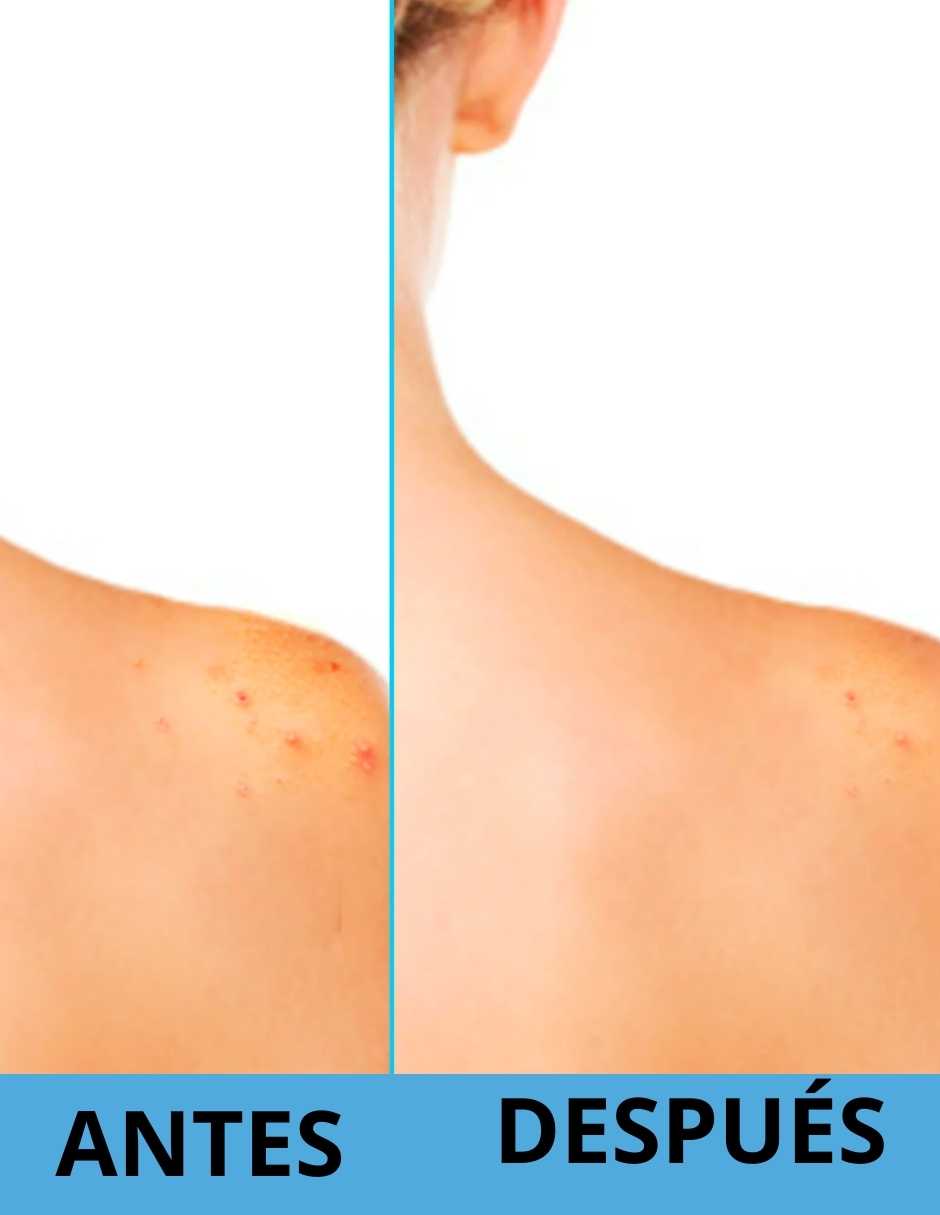 Differin Spray corporal limpiador de acné con ácido salicílico 170gr